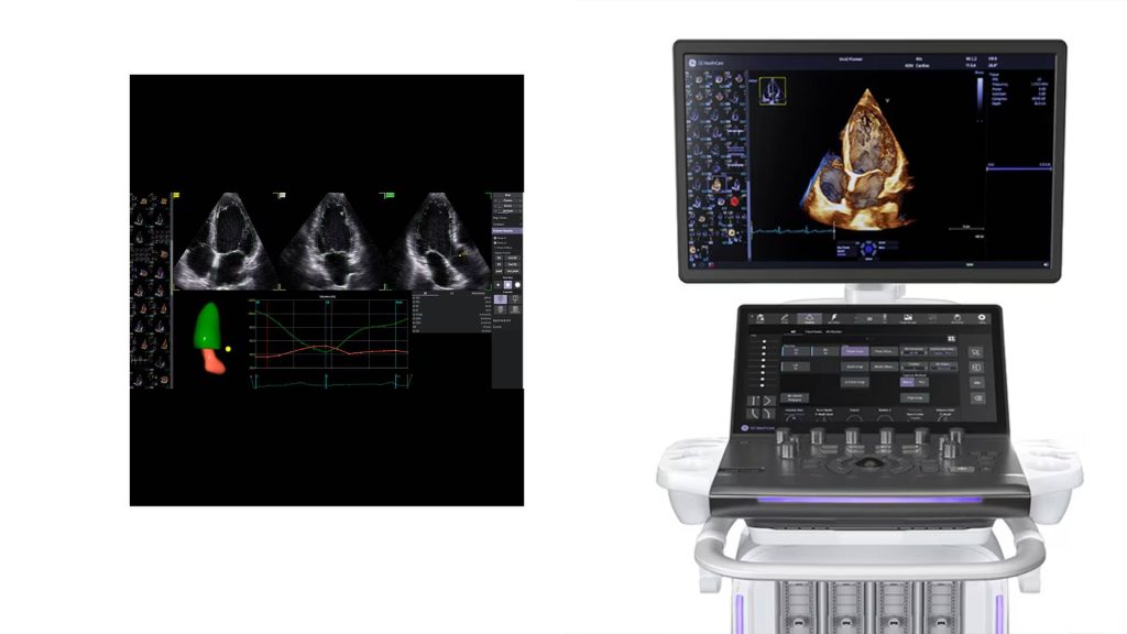 GE เปิดตัวเครื่องอัลตราซาวนด์หัวใจ เสริมด้วย AI ตรวจได้เร็วและแม่นยำขึ้น